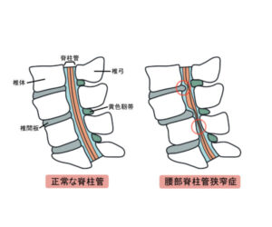 脊柱管狭窄症　足のしびれの原因