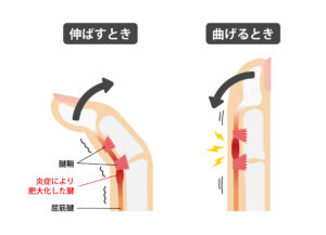 ばね指を説明するイラスト